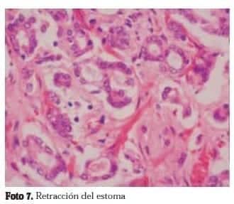 Retracción del estoma