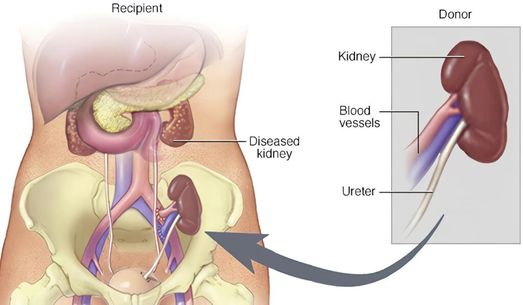 Reporte de Caso: Estrechez Pieloureteral en Riñón Transplantado