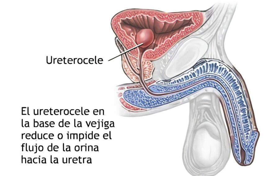 Ureteroceles