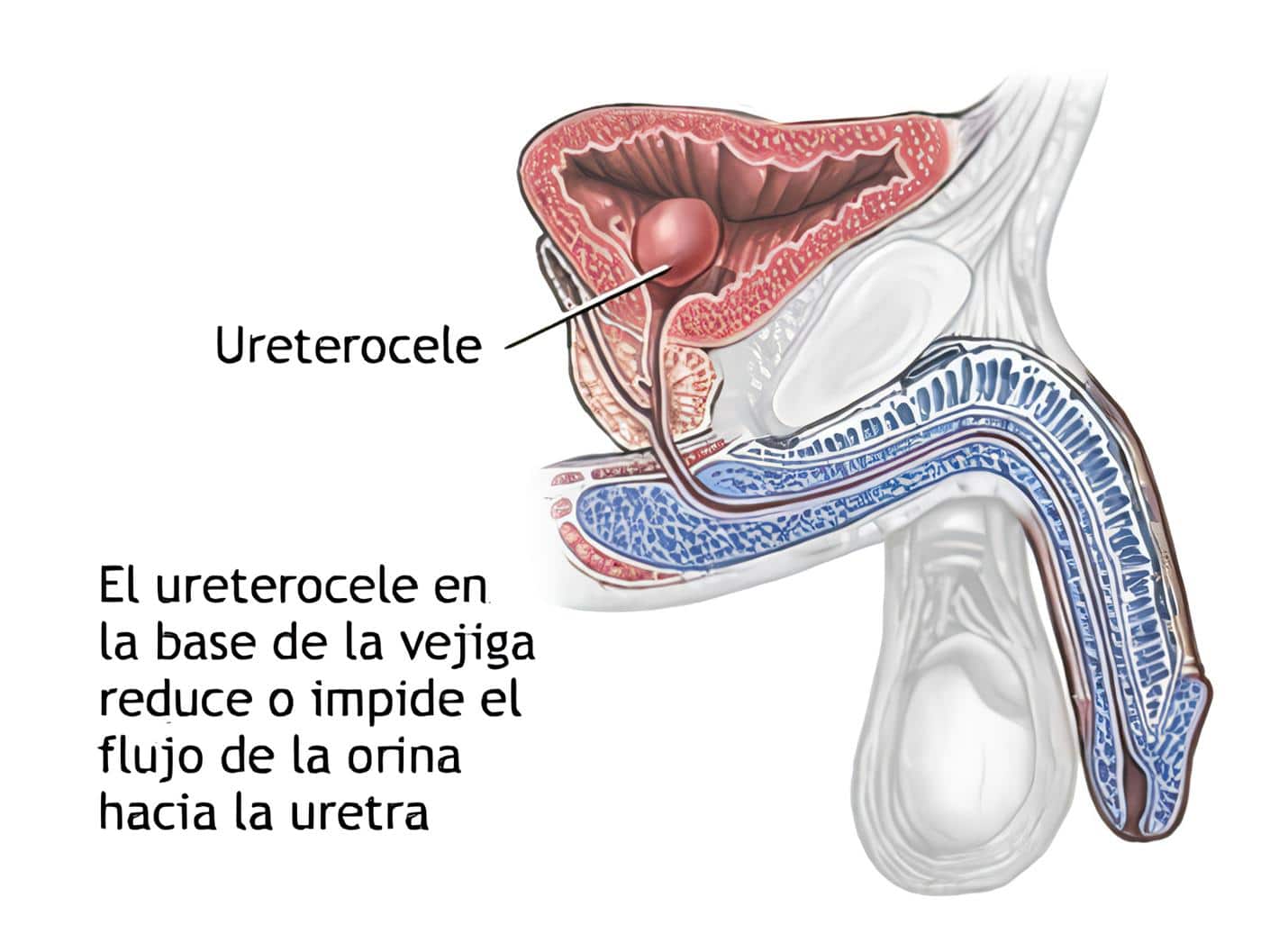 Ureteroceles