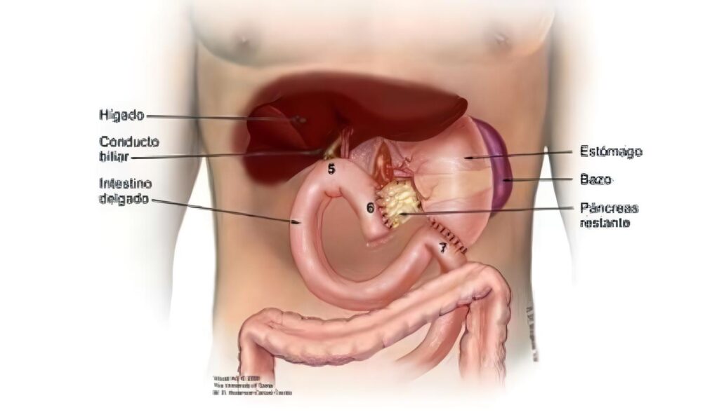 Anastomosis Hepático-Yeyuno