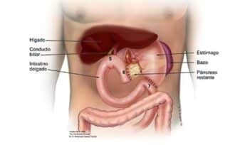 Anastomosis Hepático-Yeyuno