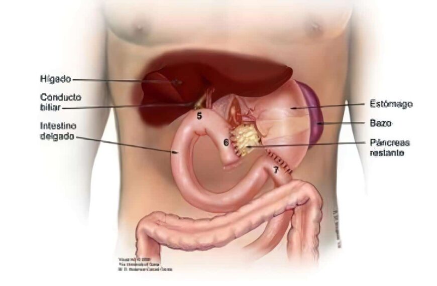 Anastomosis Hepático-Yeyuno