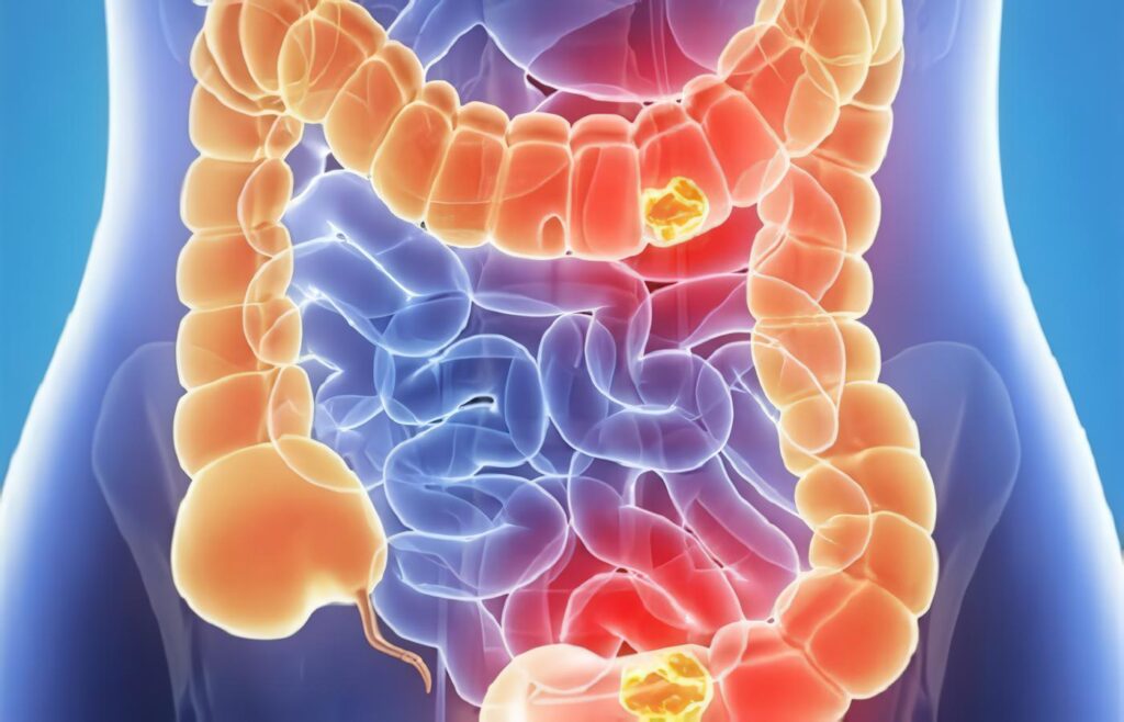 Cáncer del Tubo Digestivo