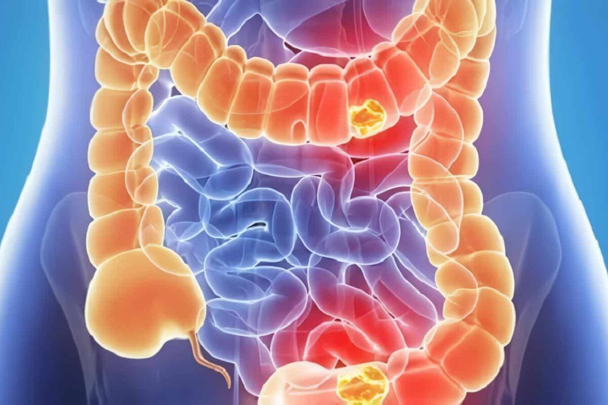 Cáncer del Tubo Digestivo