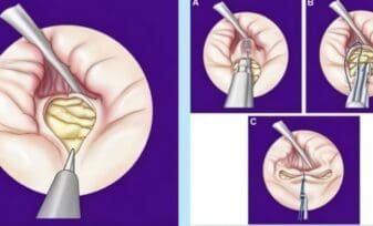 Endopielotomia con Acucise