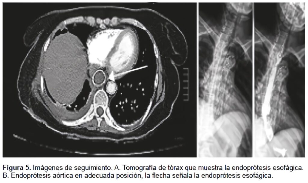 Tomografía de Tórax: Endoprótesis Esofágica y Endoprótesis Aórtica