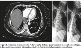 Tomografía de Tórax: Endoprótesis Esofágica y Endoprótesis Aórtica