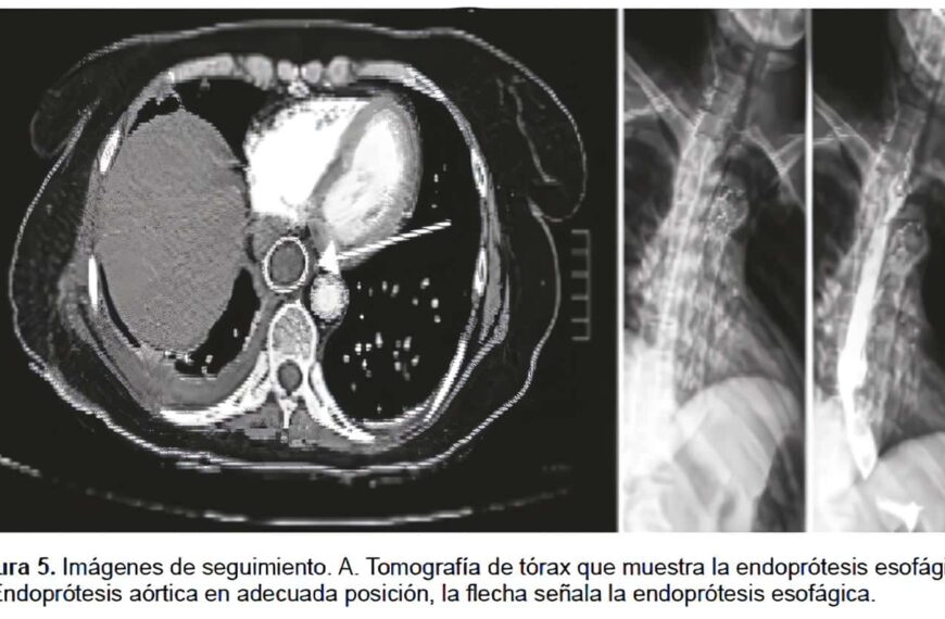 Tomografía de Tórax: Endoprótesis Esofágica y Endoprótesis Aórtica