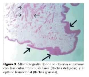 Estroma con Fascículos Fibromusculares