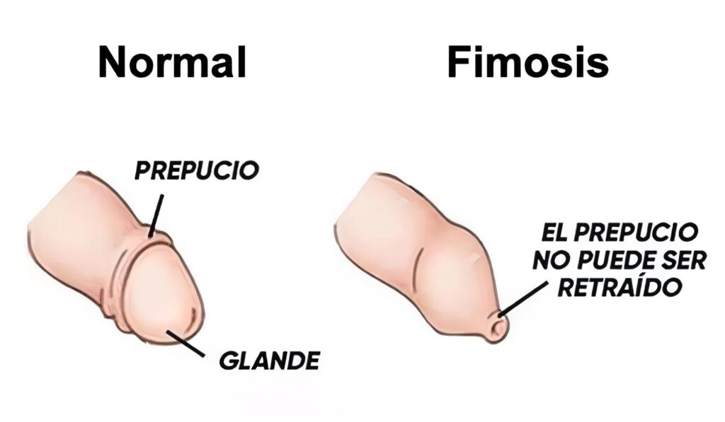 Fimosis Patológica