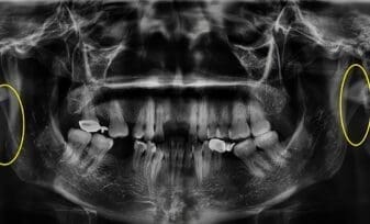 Ligamento Estilohioideo