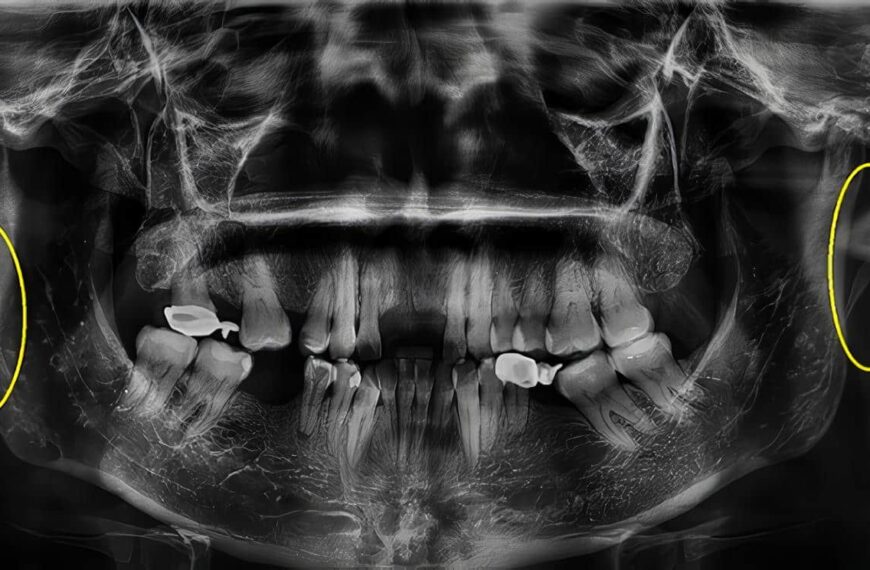 Ligamento Estilohioideo