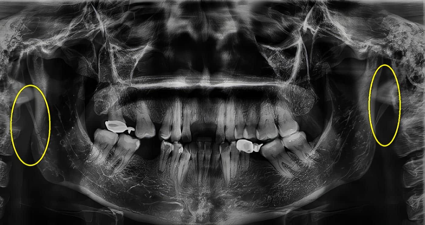 Ligamento Estilohioideo