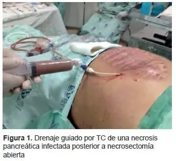 Drenaje Guiado por TC de una Necrosis Pancreática Infectada