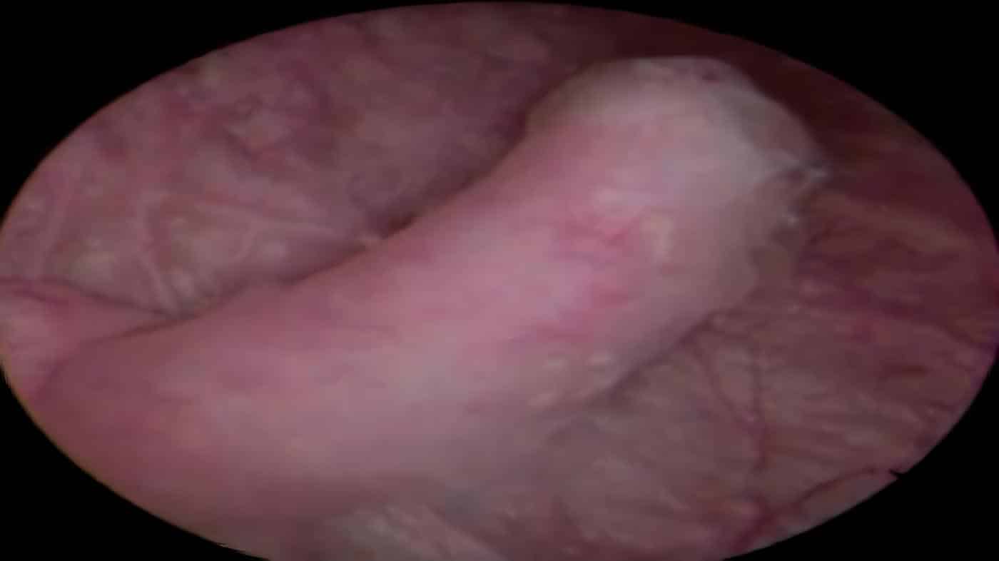 Pólipo Fibroepitelial Obstrucción Unión Pieloureteral