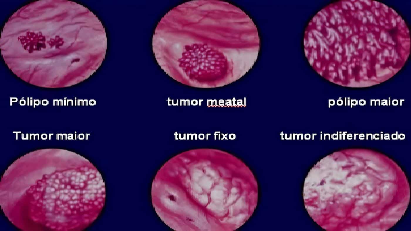 Tumores Vesicales