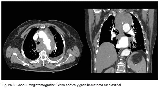 Úlcera Aórtica y gran Hematoma Mediastinal