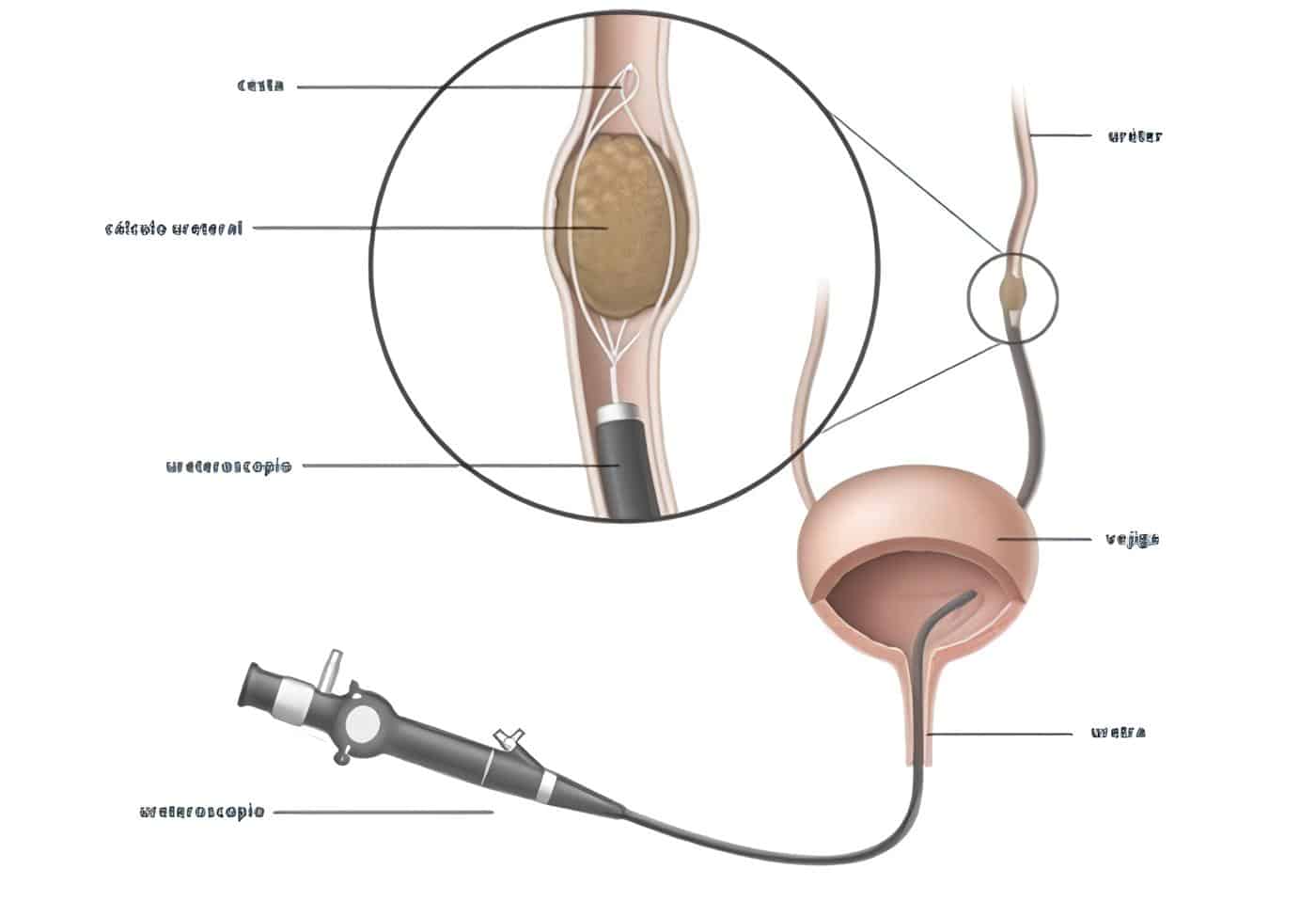 Ureterolitotomía Endoscópica