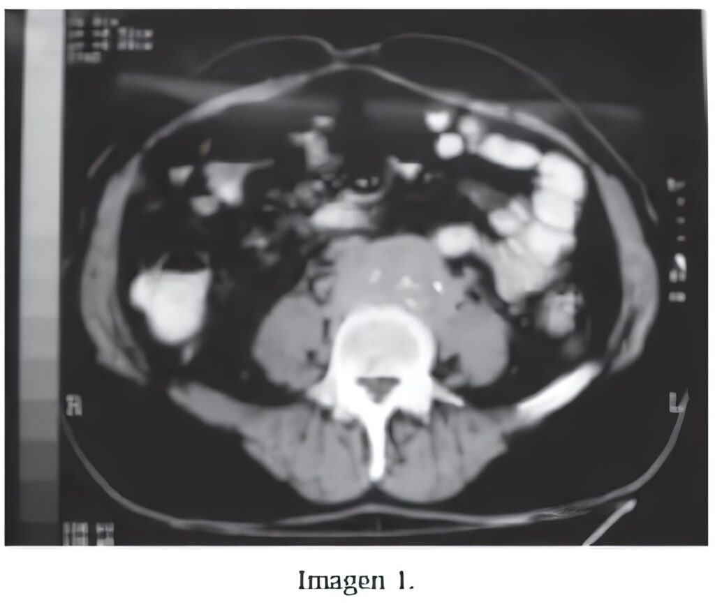 Fibrosis Retroperitoneal