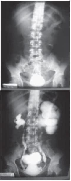 Urografía excretora, Litiasis Vesical