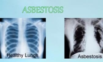 Asbestosis