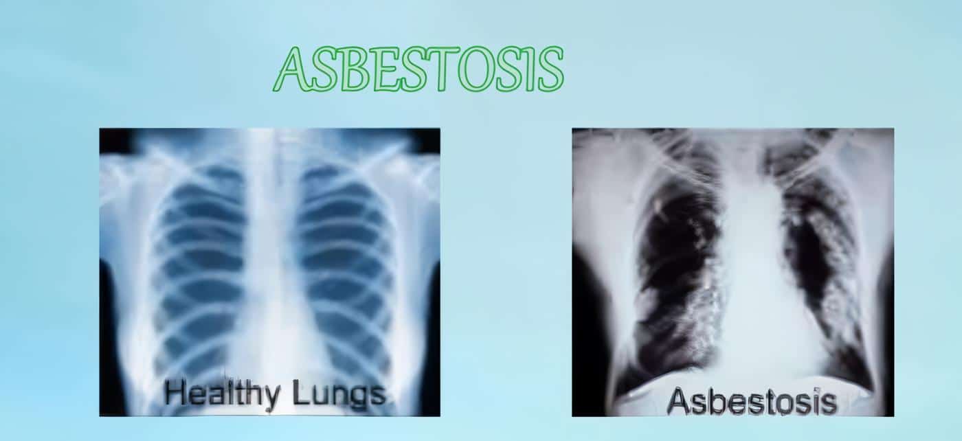 Asbestosis