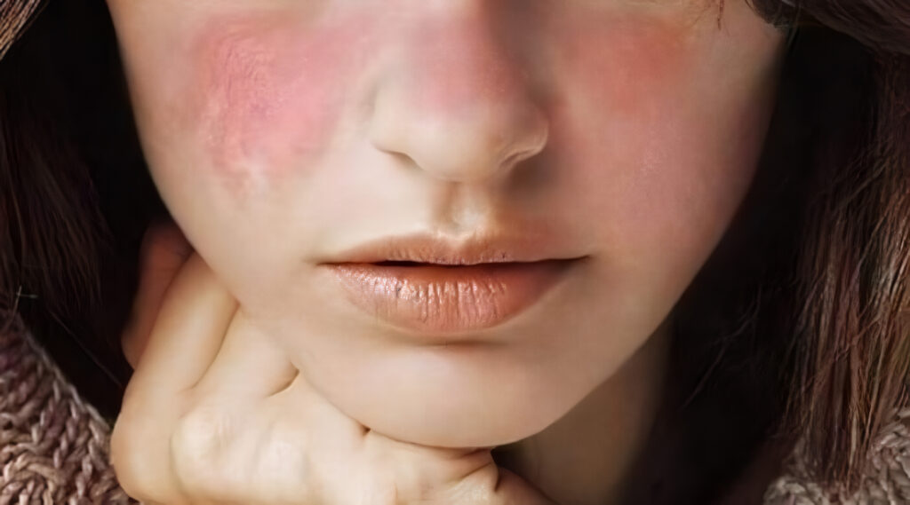 Lupus, Guía de Salud