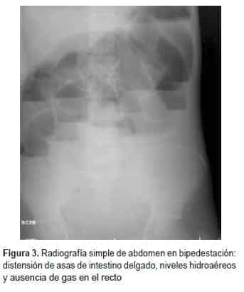 Radiografía simple de abdomen en bipedestación