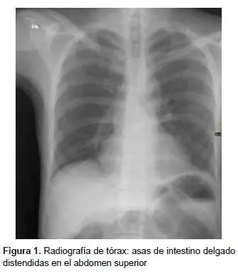 Radiografía de tórax: asas de intestino delgado distendidas