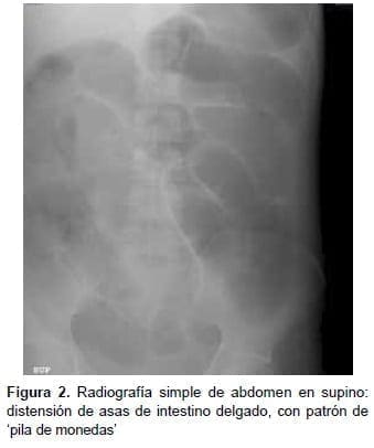 Radiografía simple de abdomen en supino