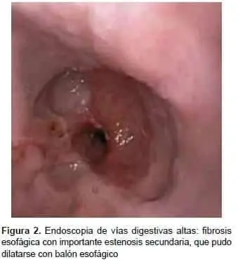 Endoscopia de vías digestivas altas: fibrosis esofágica