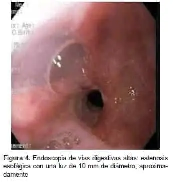 Endoscopia de vías digestivas altas: estenosis esofágica