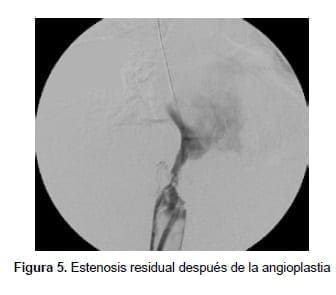 Estenosis residual después de la angioplastia