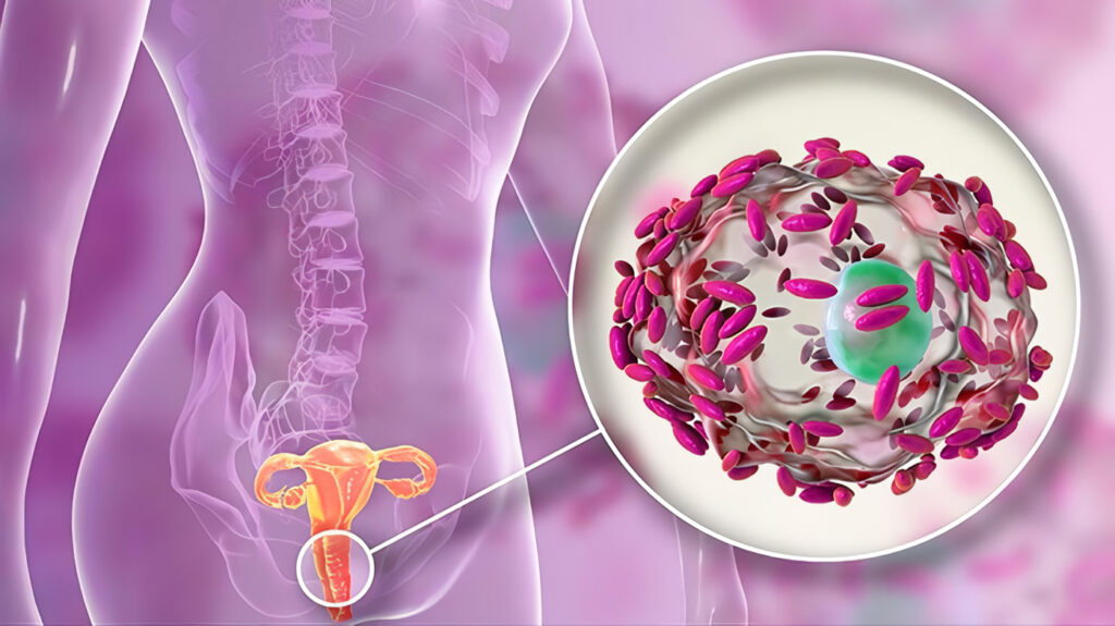 Remedios caseros para la vaginosis
