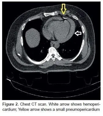 Hemopericardio, Chest CT scan. White arrow shows hemopericardium