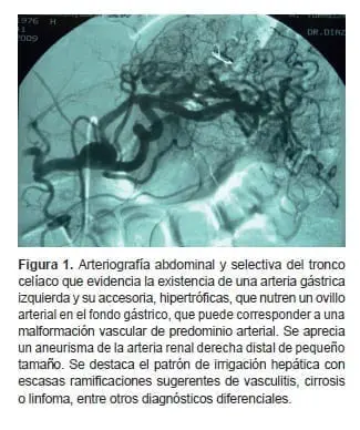 Arteriografía abdominal y selectiva del tronco celíaco
