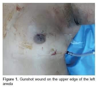 Hemopericardio, Gunshot wound on the upper edge of the left areola