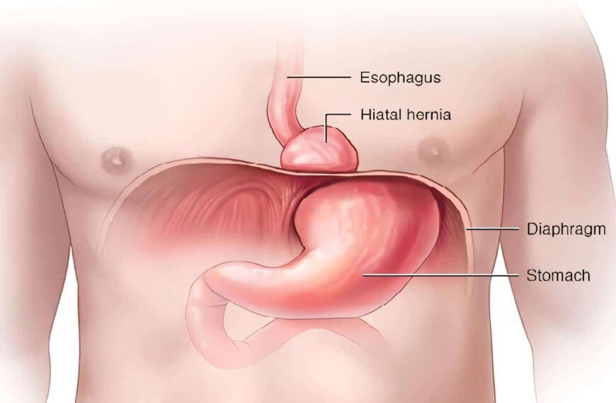 Hernia Hiatal