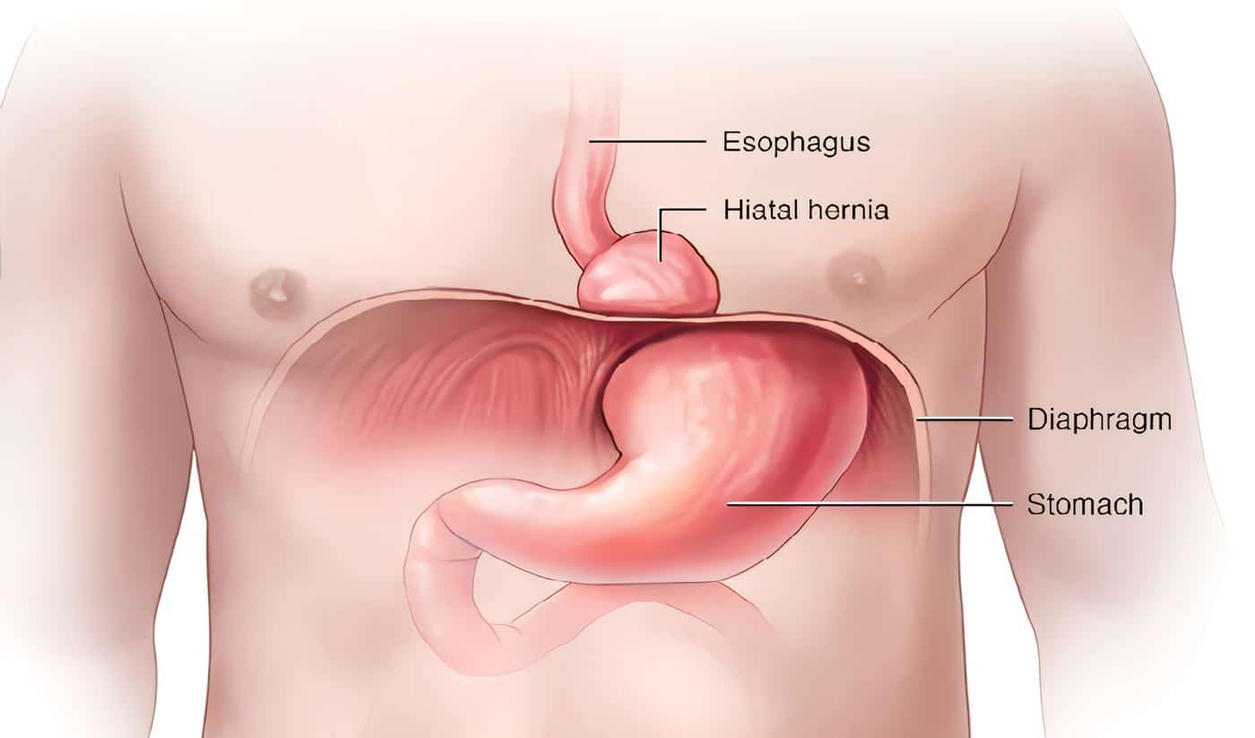 Hernia Hiatal