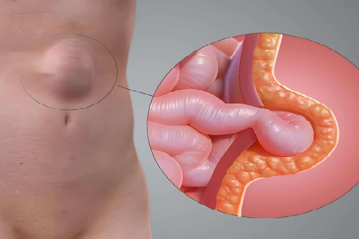 Hernia Ventral