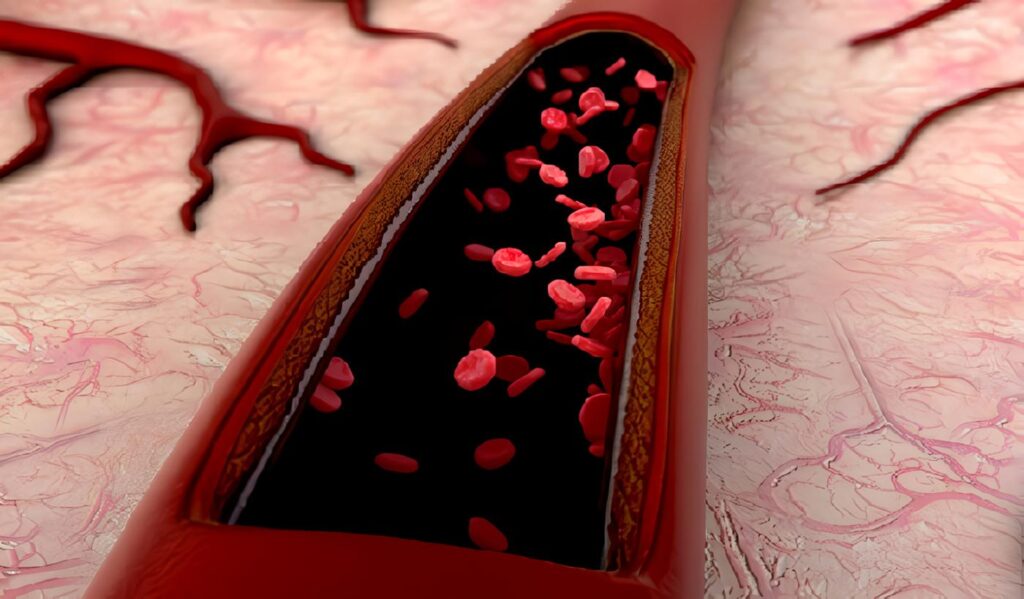 Isquemia Arterial Aguda