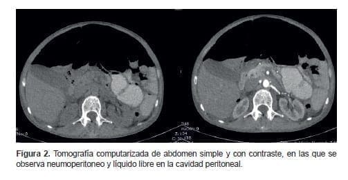 Neumoperitoneo y líquido libre en la cavidad peritoneal