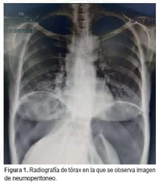 Radiografía de tórax en la que se observa imagen de neumoperitoneo