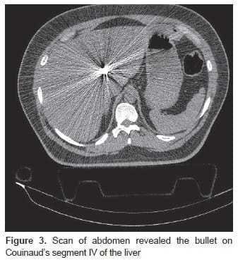Scan of abdomen revealed the bullet on Couinaud’s segment
