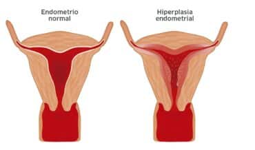 Ablación Endometrial