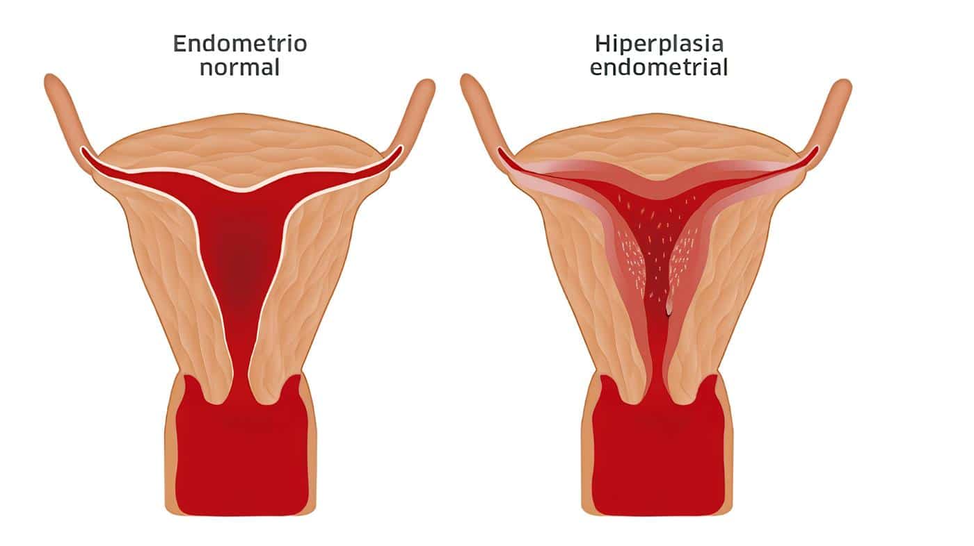 Ablación Endometrial