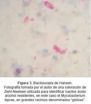 Baciloscopia de Hansen.