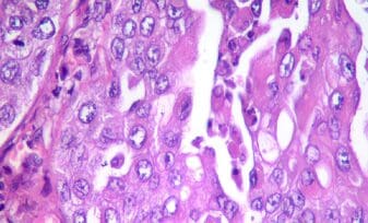 Carcinoma de Células Transicionales - CCT