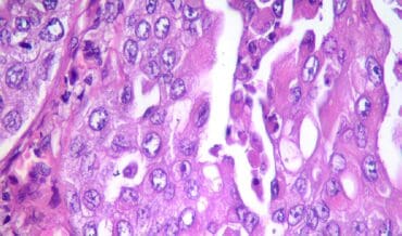 Carcinoma de Células Transicionales - CCT
